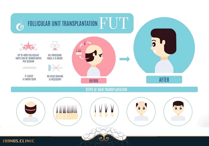 کاشت مو به روش FUT