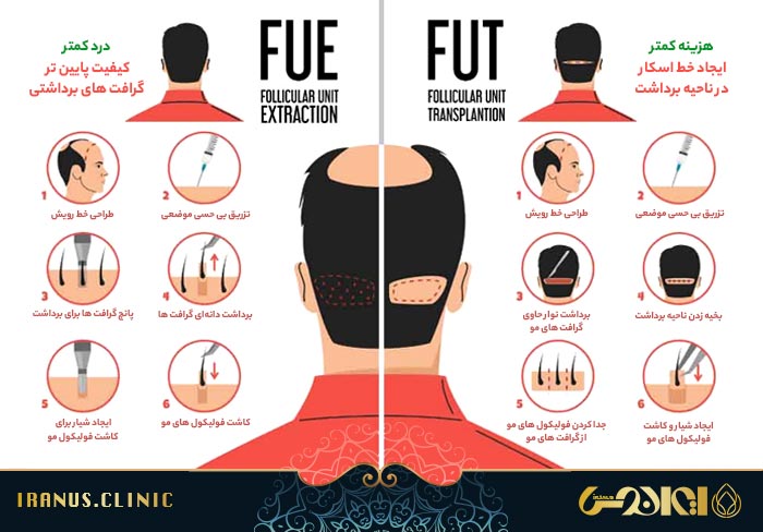 مقایسه روش FUT با FUE