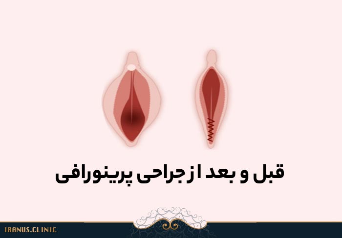 قبل و بعد از پرینورافی