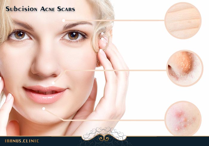 سابسیژن لک و آکنه های صورت
