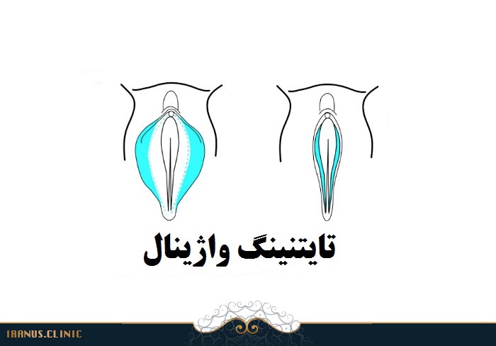تایتنینگ چیست