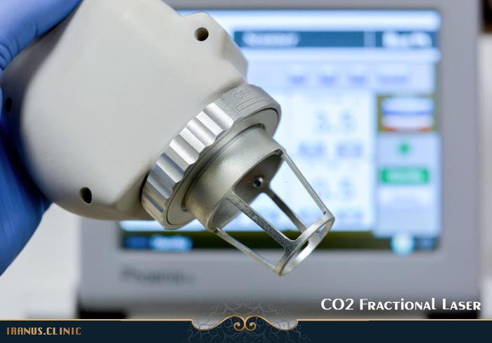 سری دستگاه لیزر فرکشنال CO2