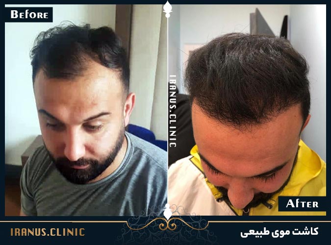 قبل و بعد از کاشت موی طبیعی