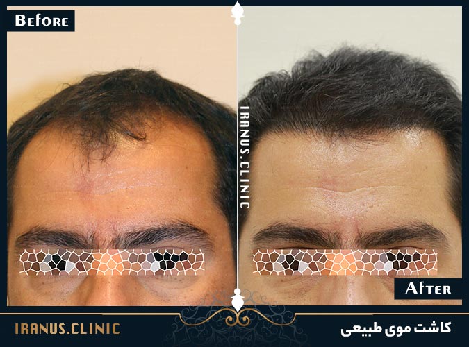 کاشت مو به روش FIT