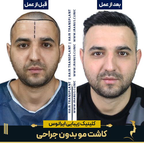 قبل و بعد از کاشت مو بدون جراحی