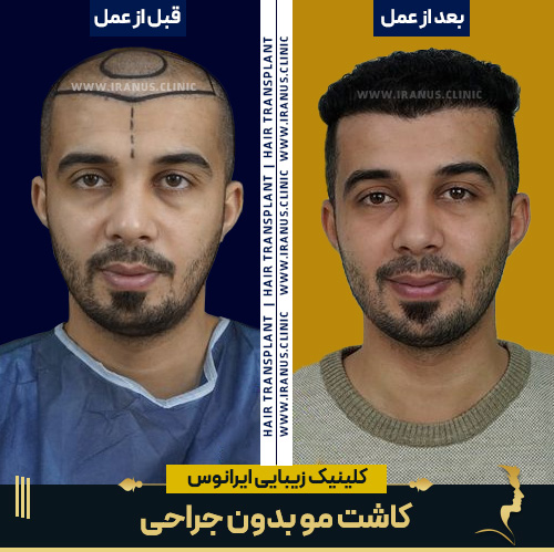 کاشت مو بدون جراحی