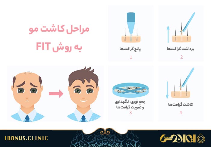 مراحل کاشت مو به روش FIT