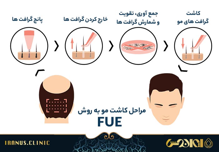 مراحل کاشت مو به روش FUE