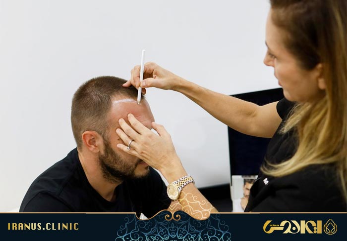 طراحی خط رویش کاشت مو
