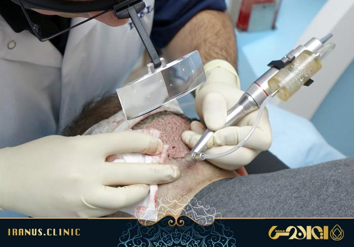 برداشت فولیکول های مو در روش FUE