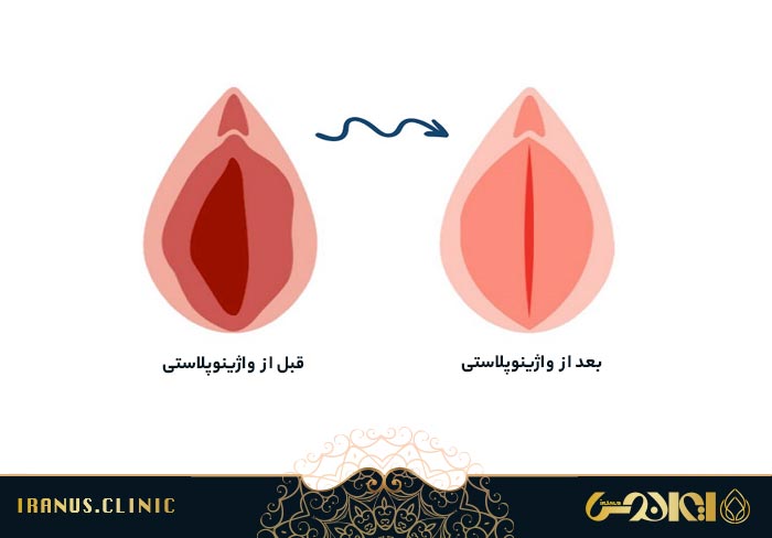 قبل و بعد از واژینوپلاستی
