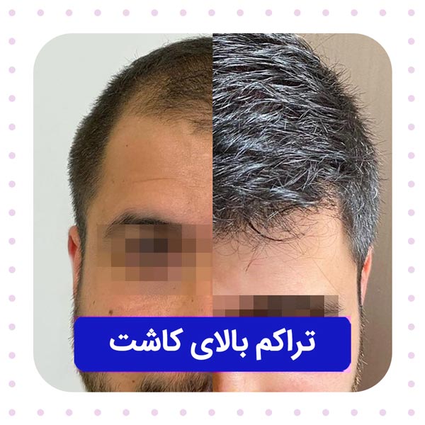 تراکم بالا در کاشت مو
