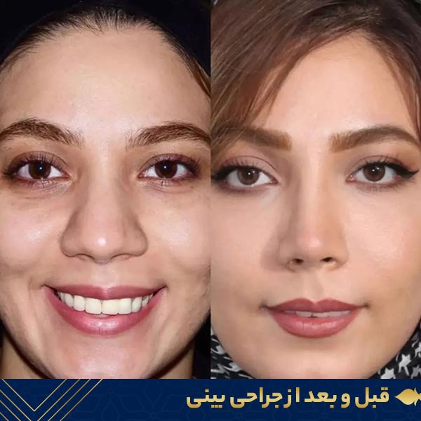 قبل و بعد از جراحی بینی