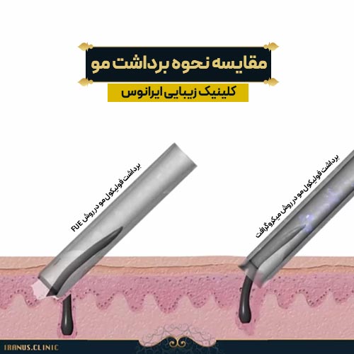 برداشت مو در روش میکروگرافت