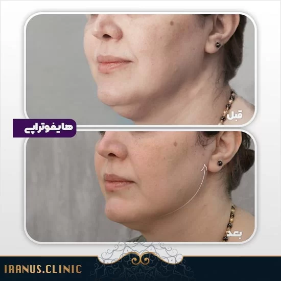 قبل و بعد از هایفوتراپی