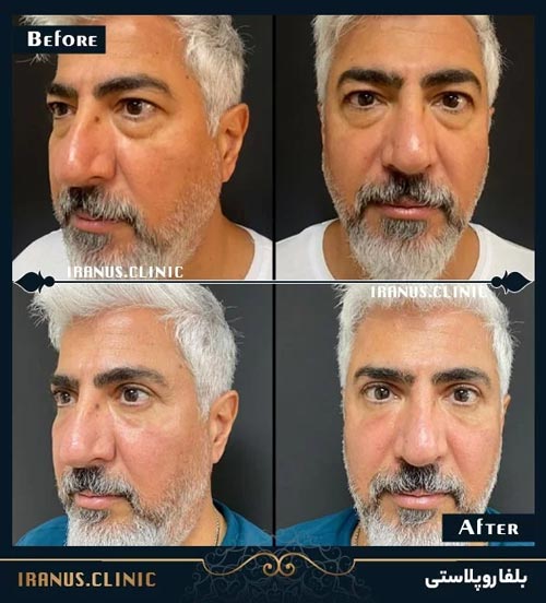 قبل و بعد از عمل جراحی پلک