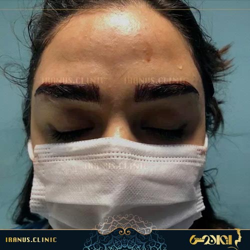 کاشت ابروی بدون جراحی