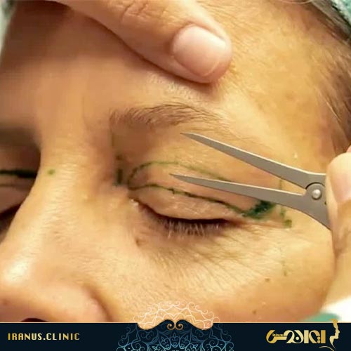طراحی پلک قبل از عمل بلفاروپلاستی