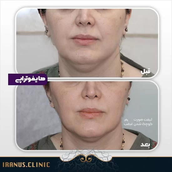 قبل و بعد از هایفوتراپی