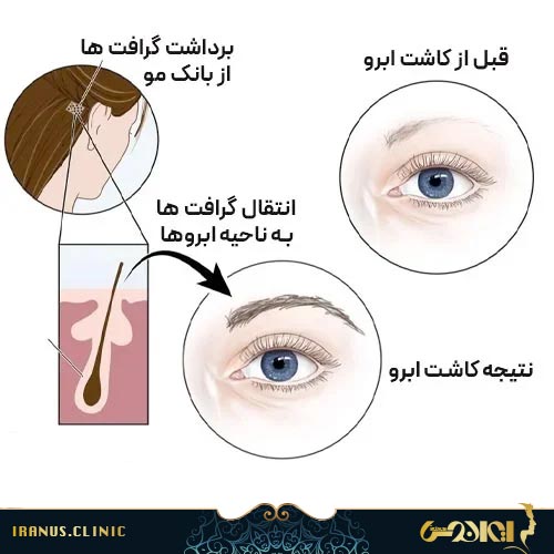 مراحل کاشت ابرو