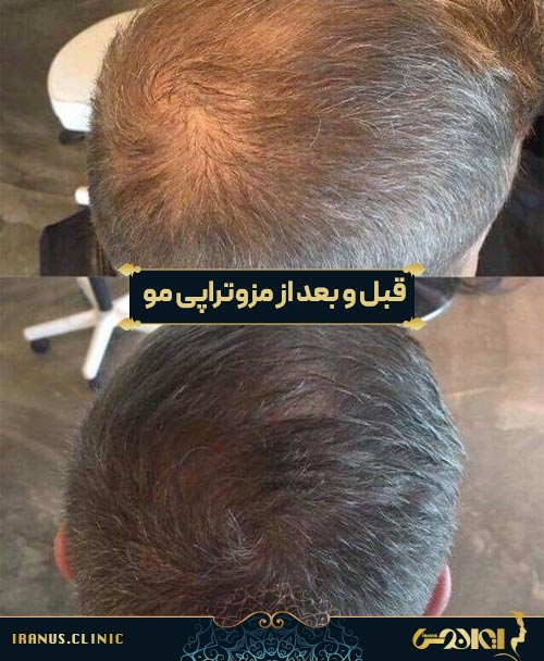 قبل و بعد از مزوتراپی مو