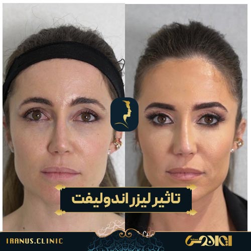 قبل و بعد از لیزر اندولیفت
