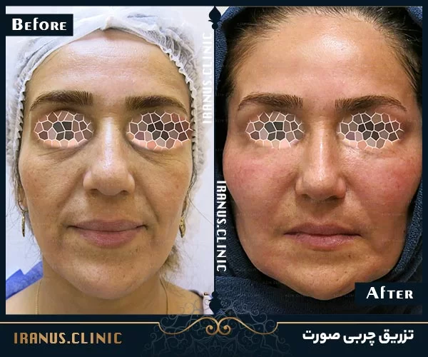 قبل و بعد از تزریق چربی به صورت