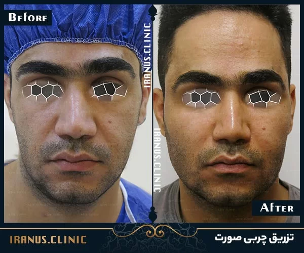 تزریق چربی به صورت