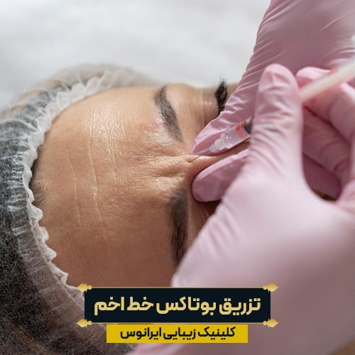 تزریق بوتاکس خط اخم