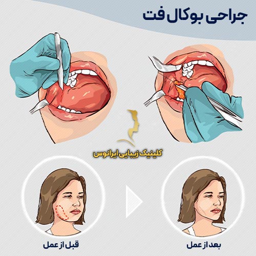 مراحل جراحی بوکال فت