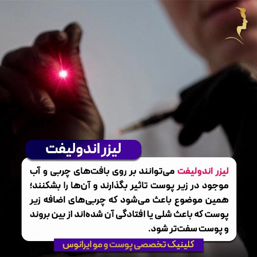 لیزر اندولیفت