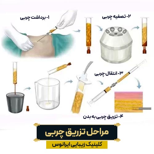 مراحل تزریق چربی