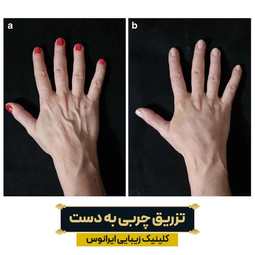 تزریق چربی به دست