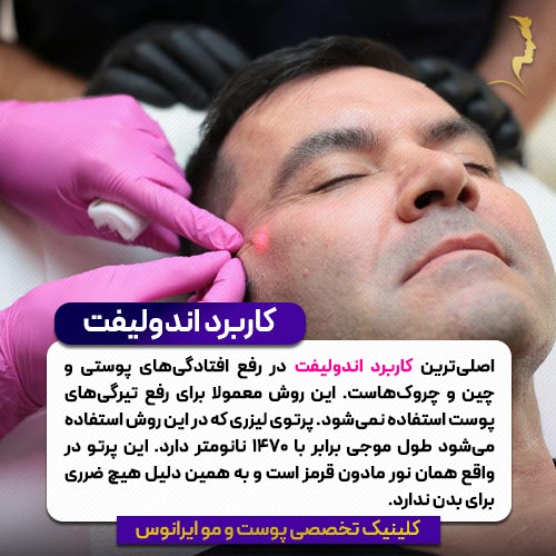کاربرد اندولیفت
