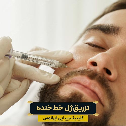 تزریق فیلر خط خنده