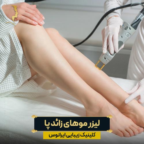 لیزر موهای زائد پا
