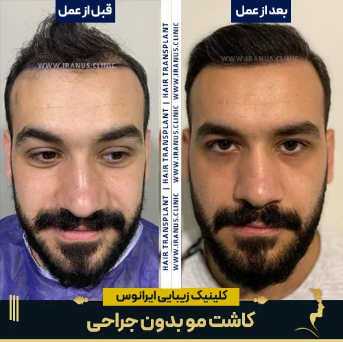 کاشت مو بدون جراحی