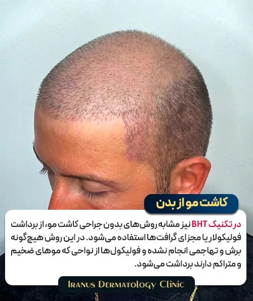 کاشت مو از بدن چیست ؟