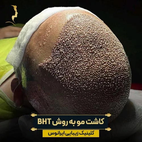 کاشت مو به روش BHT