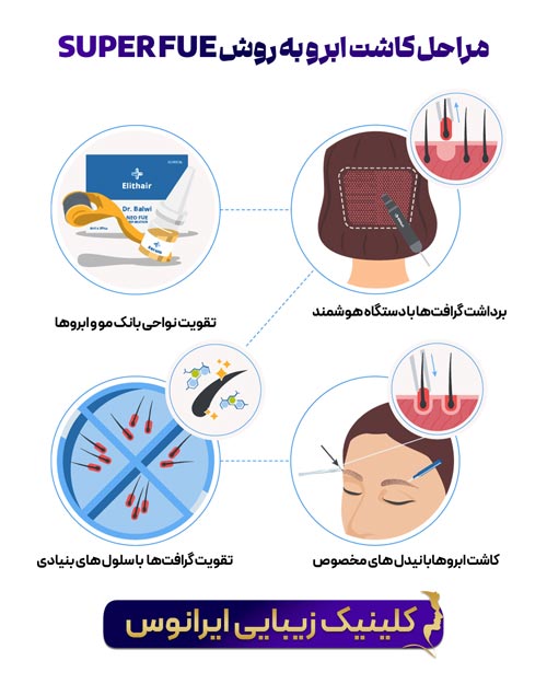 مراحل کاشت ابرو به روش SUPER FUE