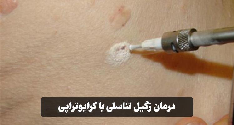 درمان زگیل تناسلی با کرایوتراپی