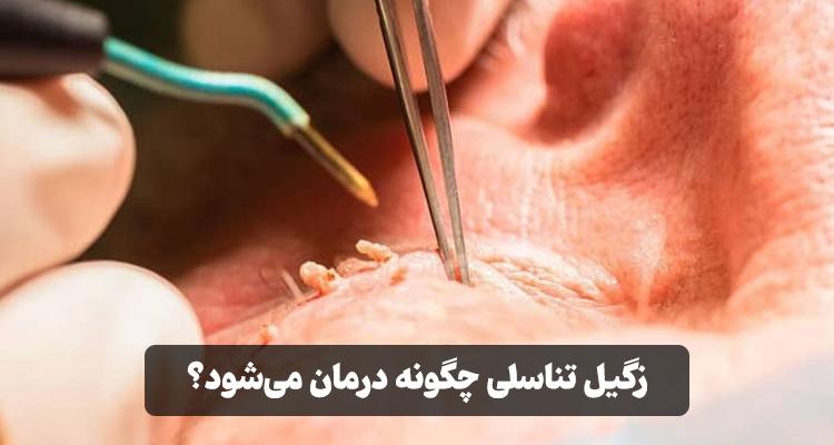 درمان زگیل تناسلی با الکتروکوتر