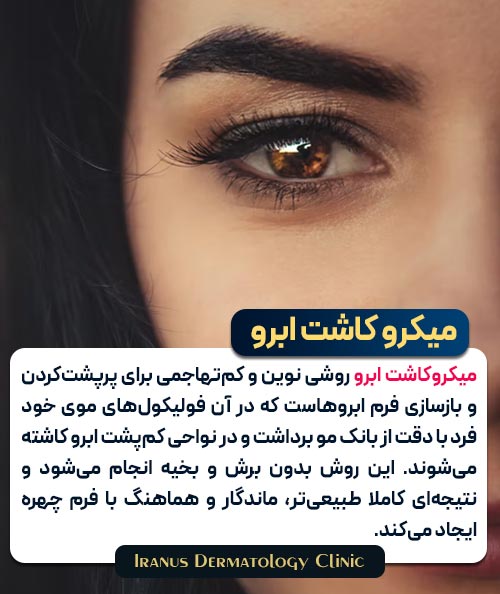 میکروکاشت ابرو