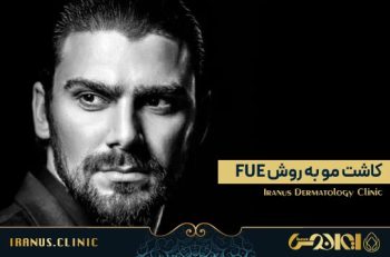 کاشت مو به روش FUE