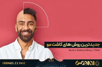 جدیدترین روش های کاشت مو