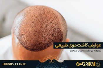 عوارض کاشت مو