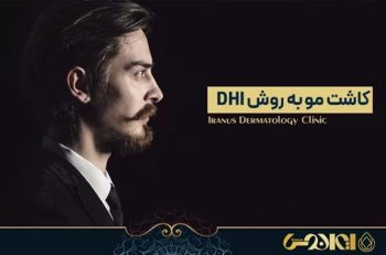 کاشت مو به روش DHI