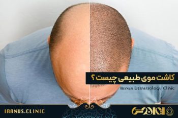 کاشت مو چیست
