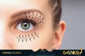هزینه جراحی پلک